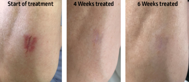Improscar Stick 50 - before after tratament cicatrice brat